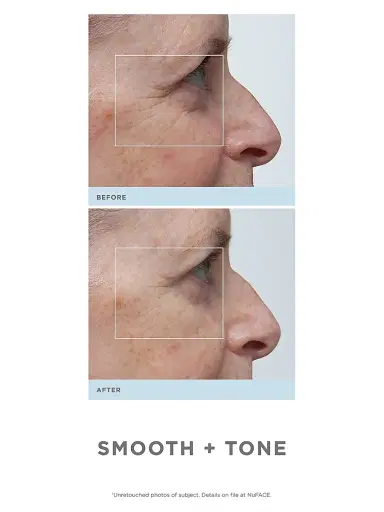 NUFACE Trinity Wrinkle Reducer | Thumbnail 3 NUFACE Trinity Wrinkle Reducer | Thumbnail 3