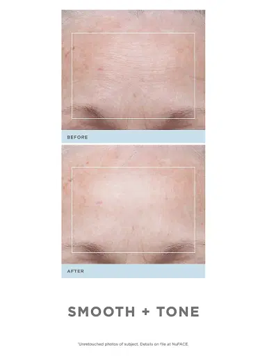 NUFACE Trinity Wrinkle Reducer | Thumbnail 4 NUFACE Trinity Wrinkle Reducer | Thumbnail 4