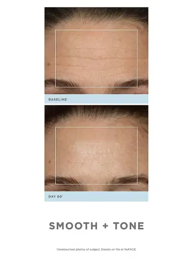 NUFACE Trinity Wrinkle Reducer | Thumbnail 5 NUFACE Trinity Wrinkle Reducer | Thumbnail 5