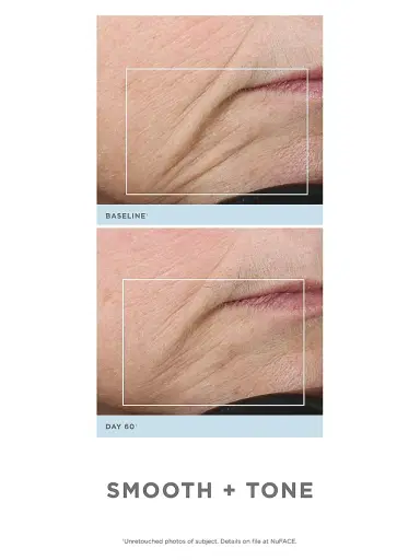 NUFACE Trinity Wrinkle Reducer | Thumbnail 6 NUFACE Trinity Wrinkle Reducer | Thumbnail 6