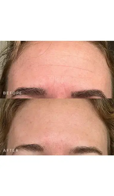 Dermaclara Forehead Occlusion Patch | Thumbnail 2