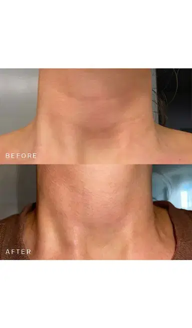 Dermaclara Neck Occlusion Patch | Thumbnail 2
