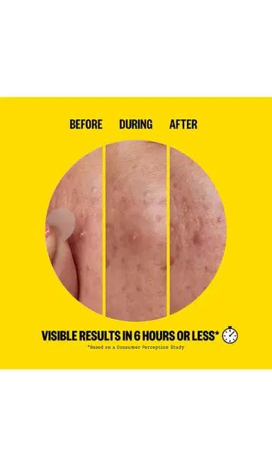 Peace Out Salicylic Acid Acne Day Dots 20 Dots | Thumbnail 2 Peace Out Salicylic Acid Acne Day Dots 20 Dots | Thumbnail 2