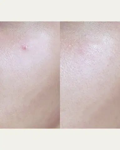 Skin Inc Deepcare Blemish SOS Patches, 12 Count | Thumbnail 3