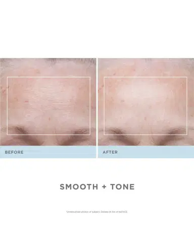 NUFACE Trinity Wrinkle Reducer Attachment | Thumbnail 3 NUFACE Trinity Wrinkle Reducer Attachment | Thumbnail 3