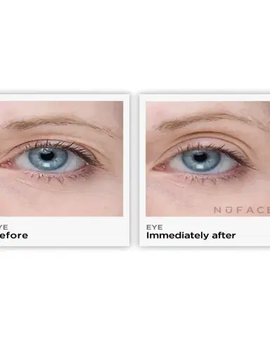 NUFACE Trinity ELE Attachment | Thumbnail 6 NUFACE Trinity ELE Attachment | Thumbnail 6