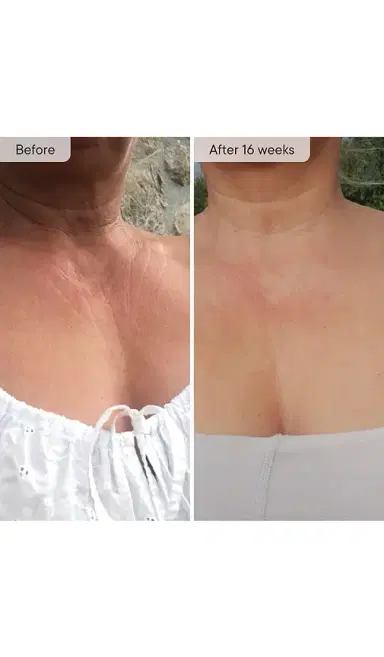 Qure Skincare Neck & Decolletage LED System | Thumbnail 3