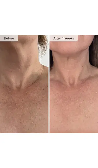 Qure Skincare Neck & Decolletage LED System | Thumbnail 4