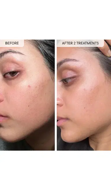 Qure Skincare Micro-Infusion For Dark Spots 3-Month Bundle | Thumbnail 3