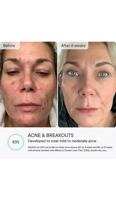 Qure Skincare Q-Rejuvalight Pro Facewear LED Mask | Thumbnail 3