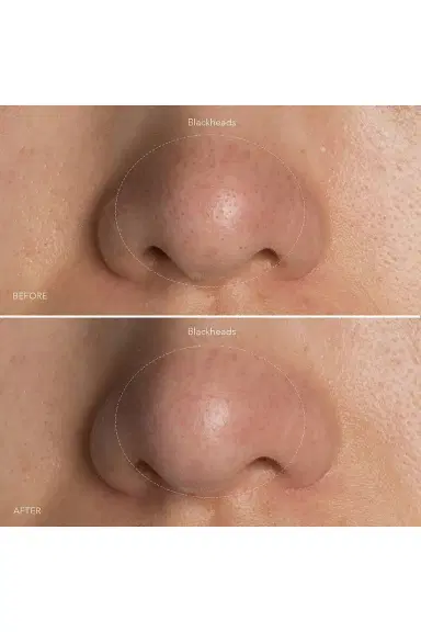 FOREO KIWI Blackhead Remover Device | Thumbnail 6 FOREO KIWI Blackhead Remover Device | Thumbnail 6