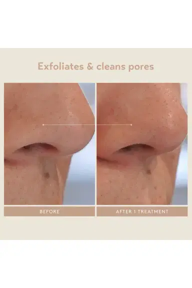 Shani Darden Skin Care Triple Acid Signature Peel 8 Treatments | Thumbnail 8 Shani Darden Skin Care Triple Acid Signature Peel 8 Treatments | Thumbnail 8