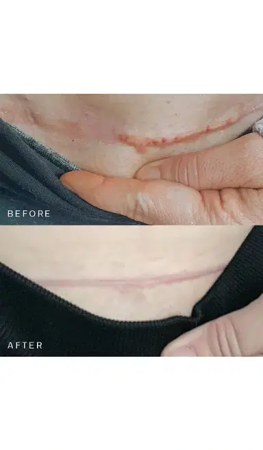Dermaclara Scar Occlusion Patch | Thumbnail 2 Dermaclara Scar Occlusion Patch | Thumbnail 2