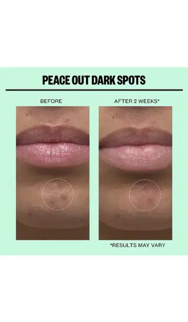 Peace Out Microneedling Dark Spot Brightening 12 Dots | Thumbnail 2 Peace Out Microneedling Dark Spot Brightening 12 Dots | Thumbnail 2