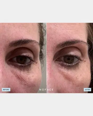 NuFace IonPlex HydraGel Eye Mask, 3.2 oz. | Thumbnail 2 NuFace IonPlex HydraGel Eye Mask, 3.2 oz. | Thumbnail 2