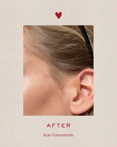 Tronque Scar Concentrate, 1 oz. | Thumbnail 4 Tronque Scar Concentrate, 1 oz. | Thumbnail 4