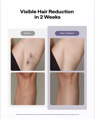 Ulike Air 10 Ice Cooling IPL Hair Removal Device | Thumbnail 4 Ulike Air 10 Ice Cooling IPL Hair Removal Device | Thumbnail 4