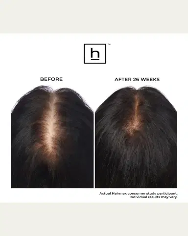 Hairmax LaserBand 82 ComfortFlex Hair Growth Device | Thumbnail 3 Hairmax LaserBand 82 ComfortFlex Hair Growth Device | Thumbnail 3