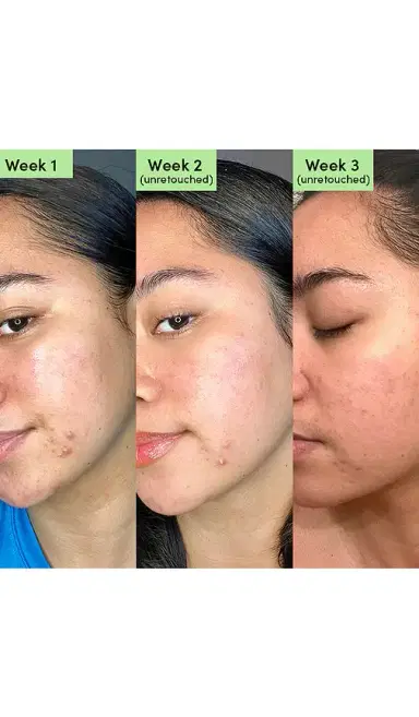 Sand & Sky Oil Control Clearing Face Mask | Thumbnail 3 Sand & Sky Oil Control Clearing Face Mask | Thumbnail 3