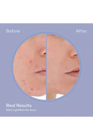 LightStim LightStim for Acne | Thumbnail 9 LightStim LightStim for Acne | Thumbnail 9