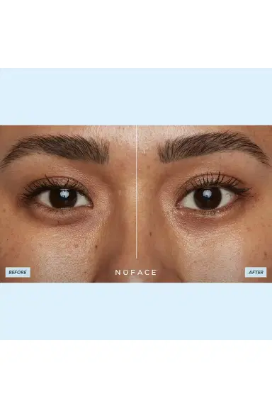 NUFACE Ionplex Hydra-Gel Power Patches | Thumbnail 6 NUFACE Ionplex Hydra-Gel Power Patches | Thumbnail 6